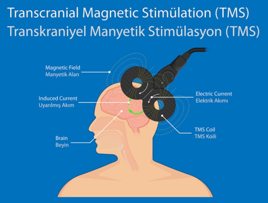 TMS THERAPY IN THE TREATMENT OF OCD